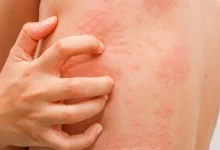 Allergiya Sip 1