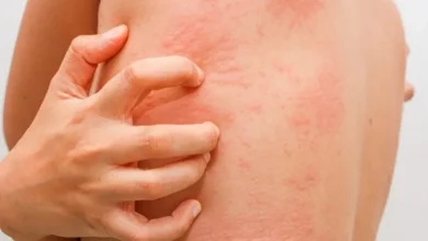 Allergiya Sip 1