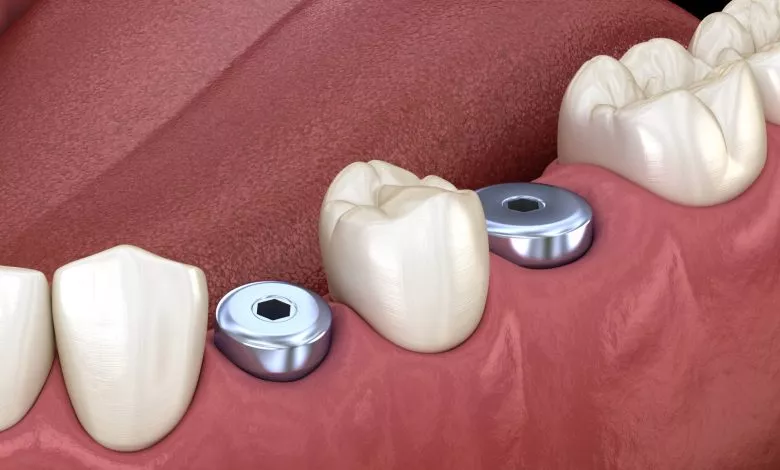 Formyrovatel Desnы Pry Ymplantaczyy