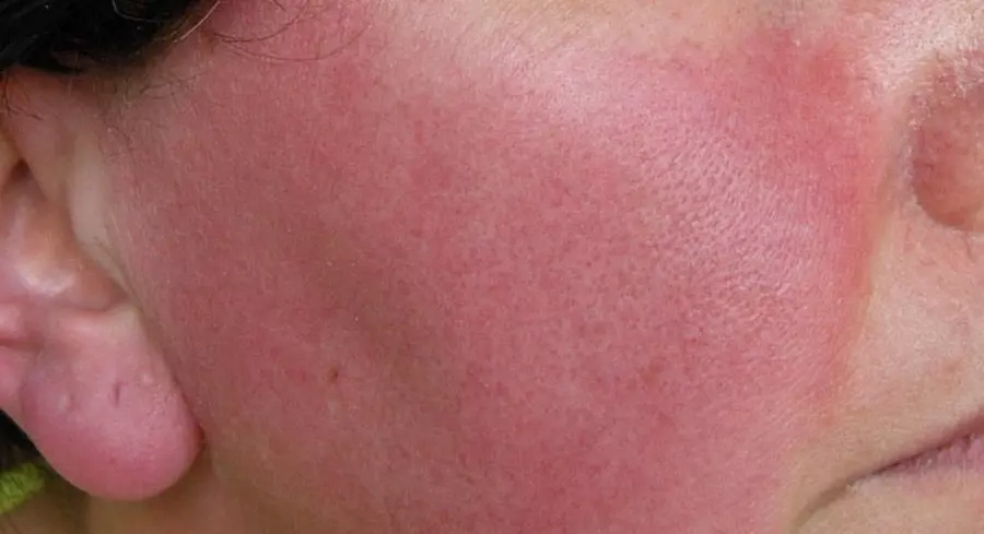 Allergiya Na Licze Krasnota